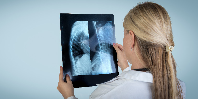 Scoliosis treatments and the Schroth method